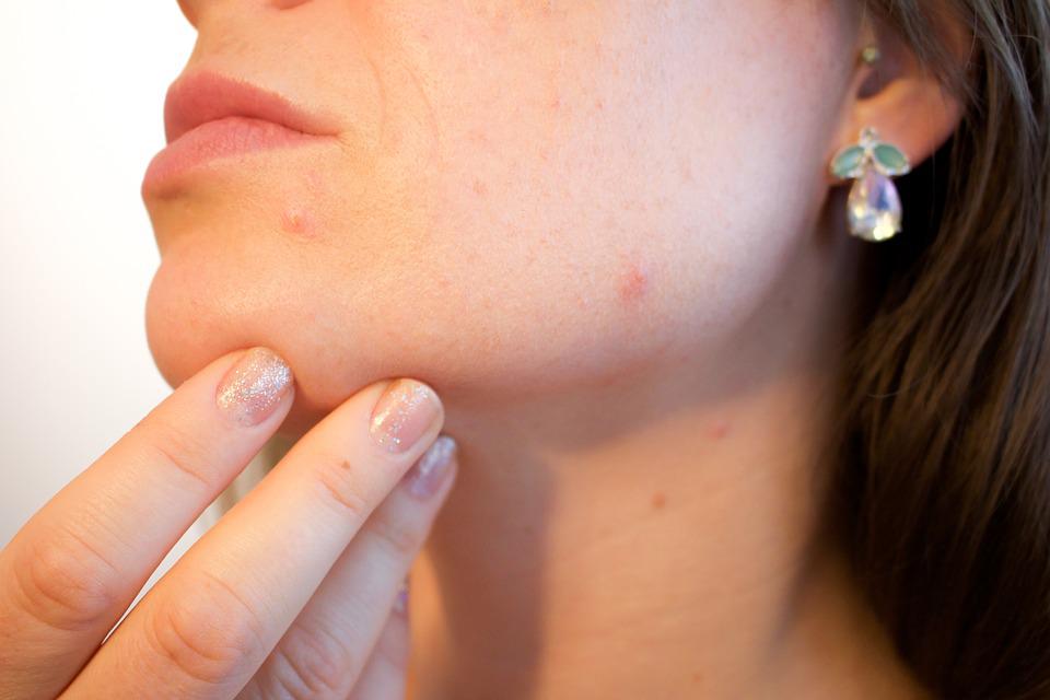 Acné : liste de traitements qui peuvent vous aider à combattre l’acné